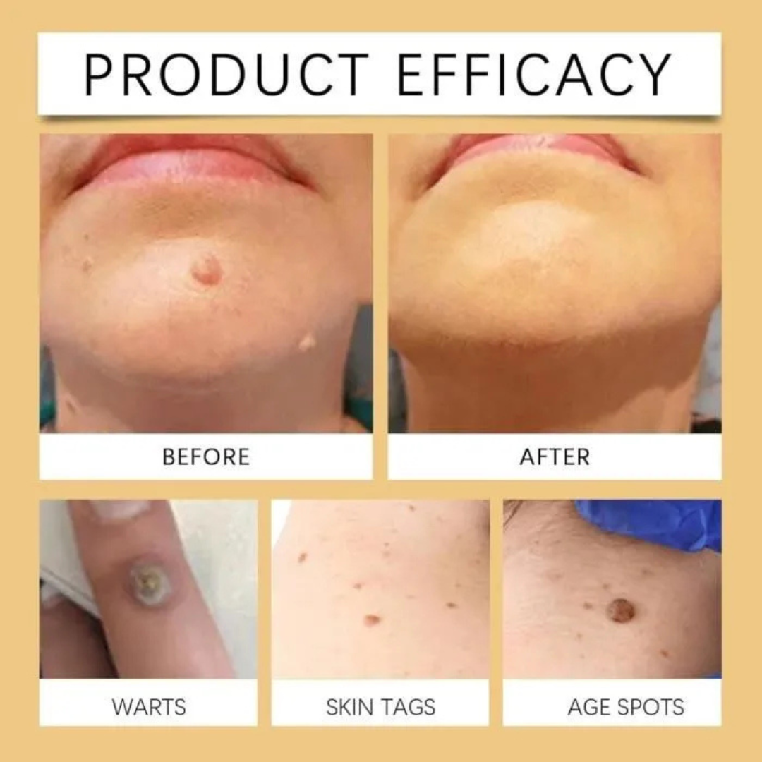 Timilk Wart & Mole Removal Spray