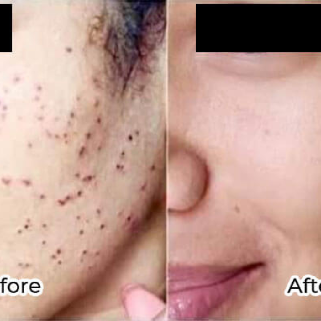 Timilk Wart & Mole Removal Spray