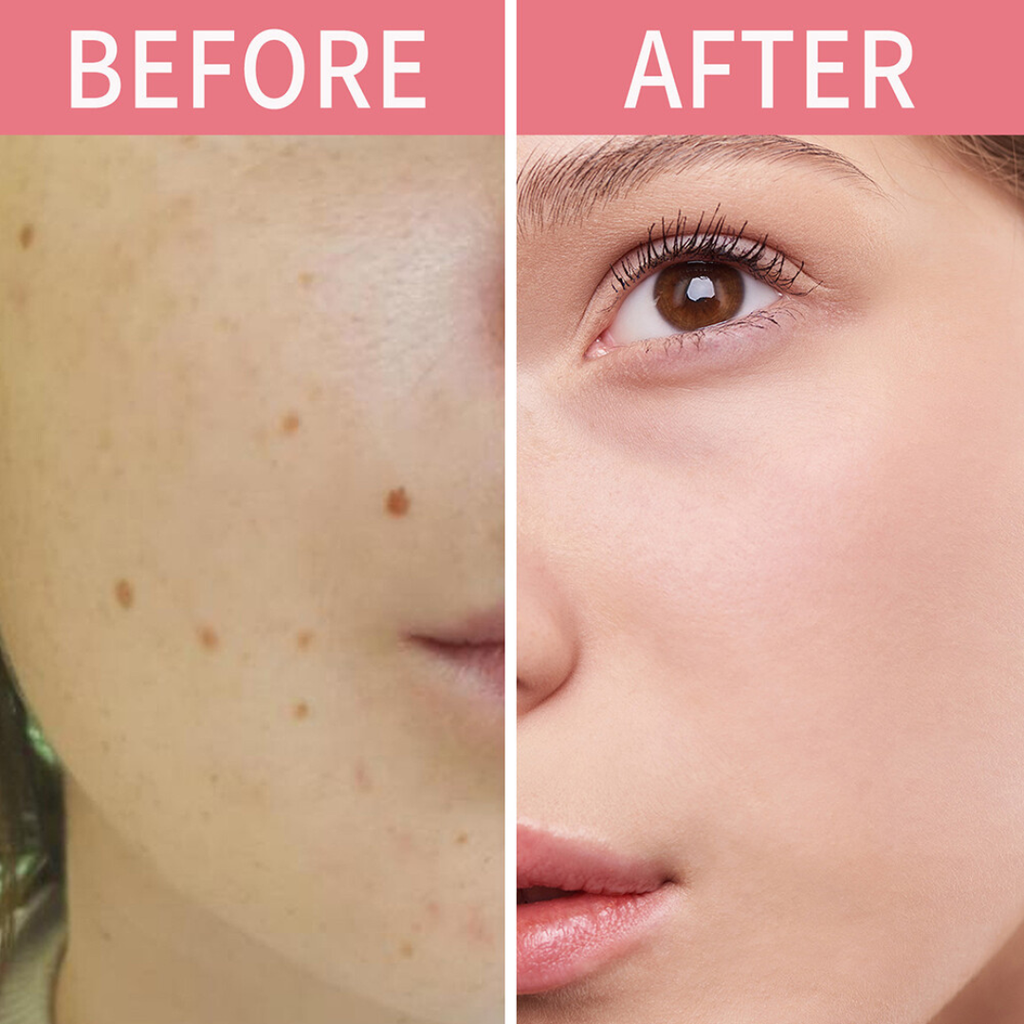 Timilk Wart & Mole Removal Spray