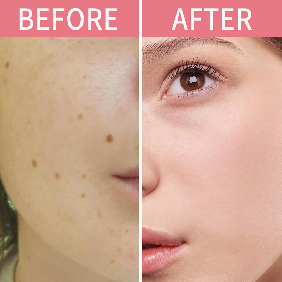 Timilk Wart & Mole Removal Spray