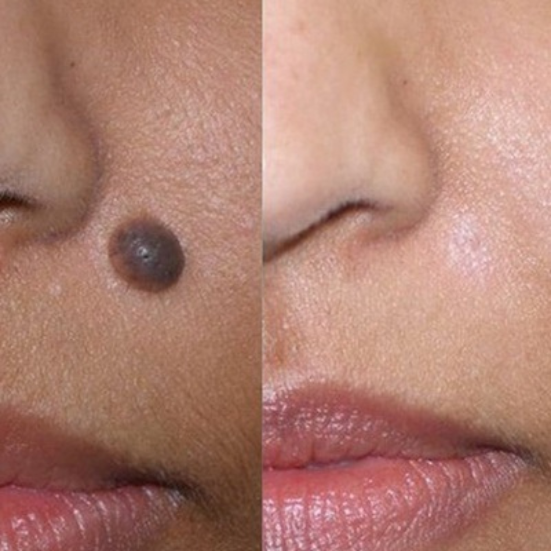 Timilk Wart & Mole Removal Spray