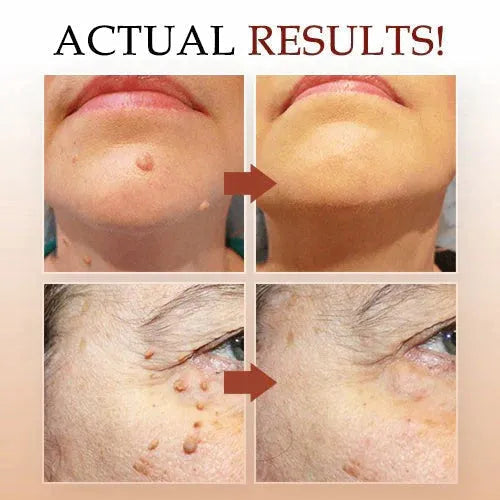 Warts, Moles & Skin Tags Remover Pen