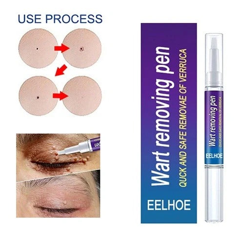 Warts, Moles & Skin Tags Remover Pen