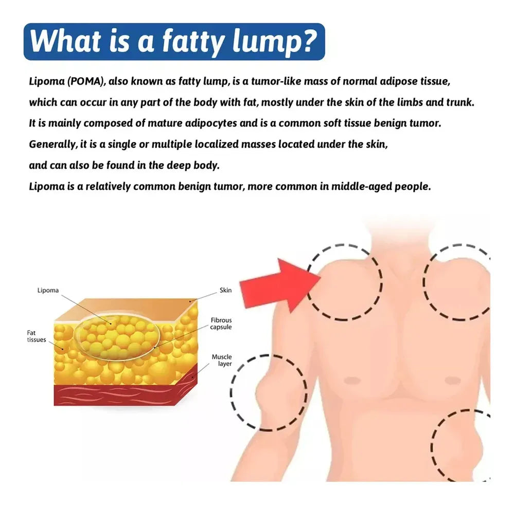 LIPOMA REMOVAL SPRAY (IMPORTED)