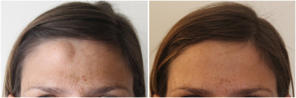 Gradual & Natural Results
