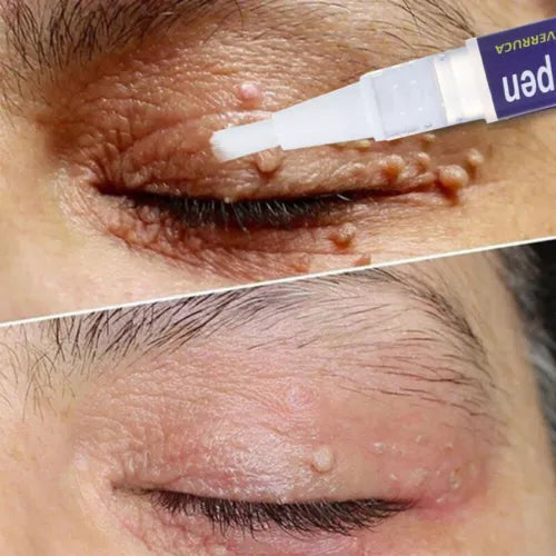 Warts, Moles & Skin Tags Remover Pen