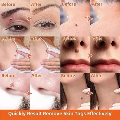 Warts, Moles & Skin Tags Remover Pen