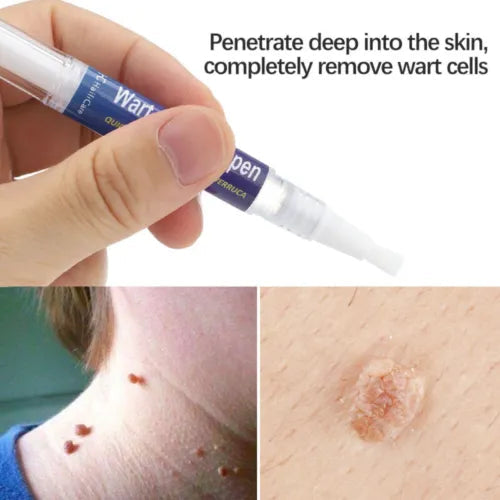 Warts, Moles & Skin Tags Remover Pen