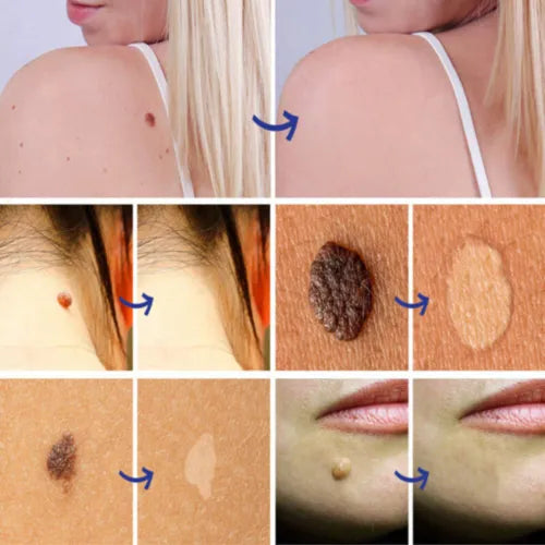 Warts, Moles & Skin Tags Remover Pen